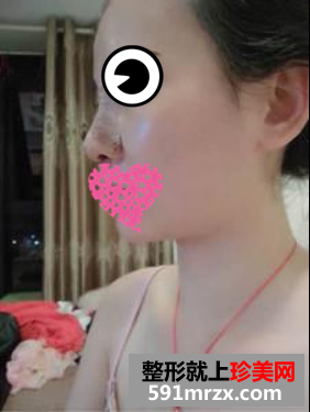 膨体隆鼻真人案例对比图
