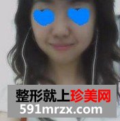 下巴后缩矫正术+耳后软骨隆鼻整形前后对比图和恢复过程