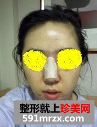 下巴后缩矫正术+耳后软骨隆鼻整形前后对比图和恢复过程