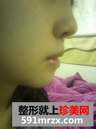 下巴后缩矫正术+耳后软骨隆鼻整形前后对比图和恢复过程