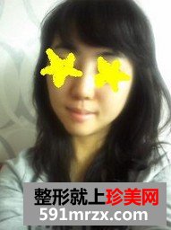下巴后缩矫正术+耳后软骨隆鼻整形前后对比图和恢复过程
