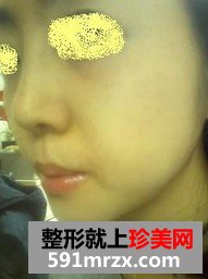 下巴后缩矫正术+耳后软骨隆鼻整形前后对比图和恢复过程