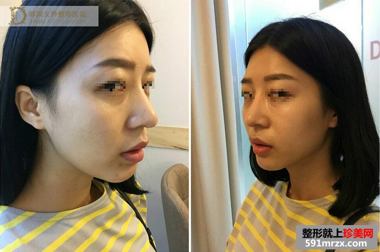 全面部自体脂肪填充前后照片对比和恢复过程记录