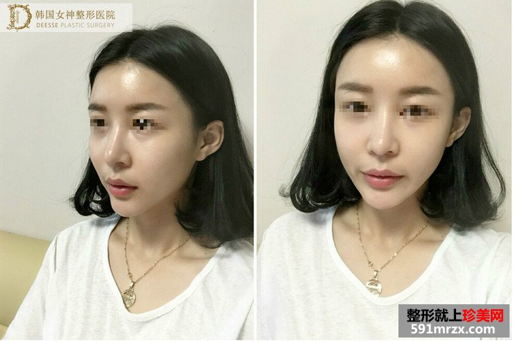 全面部自体脂肪填充前后照片对比和恢复过程记录
