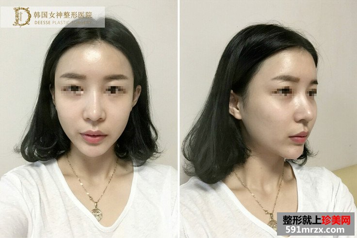 全面部自体脂肪填充前后照片对比和恢复过程记录