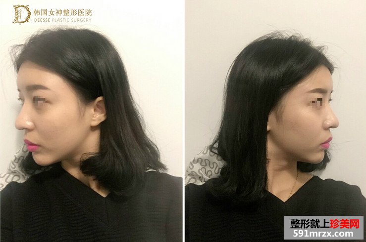 全面部自体脂肪填充前后照片对比和恢复过程记录