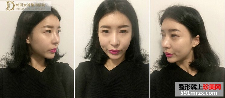 全面部自体脂肪填充前后照片对比和恢复过程记录