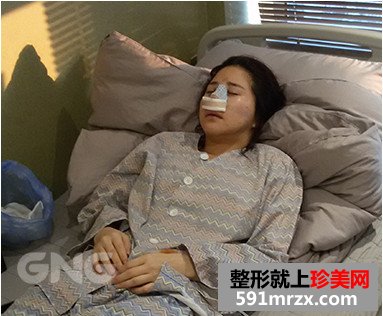 硅胶假体隆鼻整形手术前后效果对比图和恢复过程