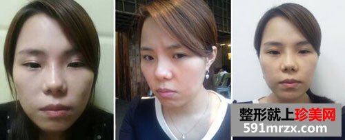 韩式无痕开眼角+膨体隆鼻整形手术前后对比图和恢复过程