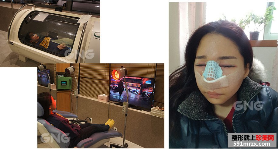 硅胶假体隆鼻整形手术前后效果对比图和恢复过程