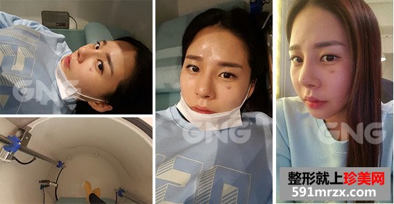 硅胶假体隆鼻整形手术前后效果对比图和恢复过程