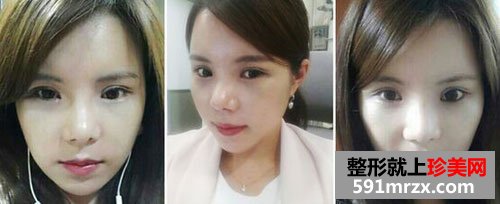韩式无痕开眼角+膨体隆鼻整形手术前后对比图和恢复过程