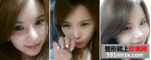 韩式无痕开眼角+膨体隆鼻整形手术前后对比图和恢复过程