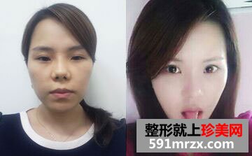 韩式无痕开眼角+膨体隆鼻整形手术前后对比图和恢复过程