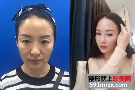 华美整形医院埋线提升除皱抗衰老真实案例分享|面部提升价格