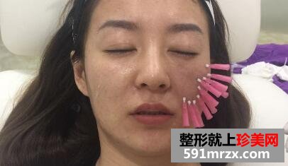 埋线提升除皱抗衰老真实案例分享