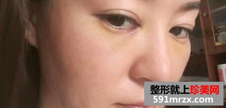 埋线提升真实案例分享|面部提升价格
