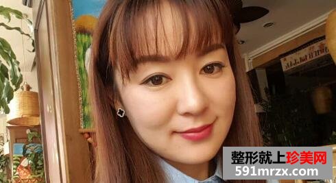 埋线提升除皱抗衰老手术前后对比图真实案例分享