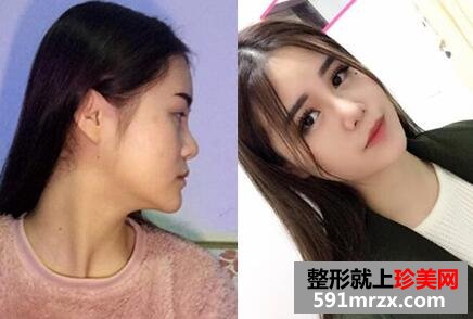 鼻综合整形价格|鼻综合整形对比照和整容过程分享