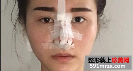 鼻综合整形对比照和整容过程分享