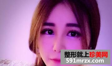 鼻综合整形价格|鼻综合整形对比图片和真实整容过程分享