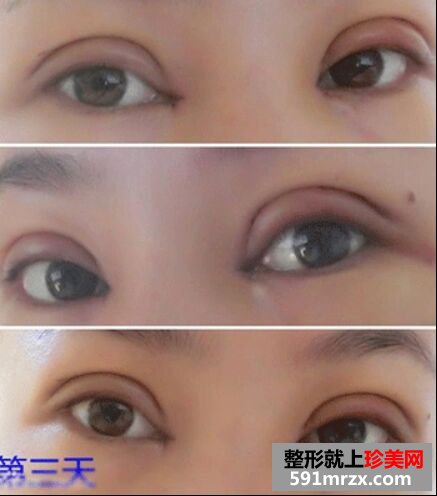 做了全切双眼皮和开内眼角过程图+恢复图