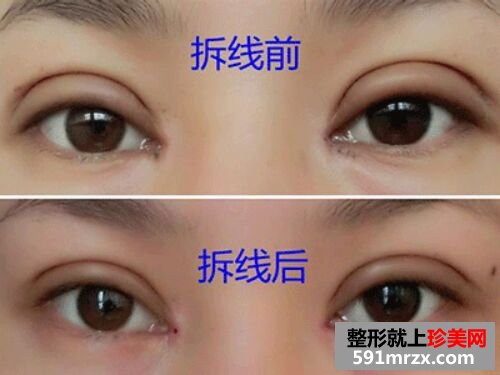 做了全切双眼皮和开内眼角过程图+恢复图