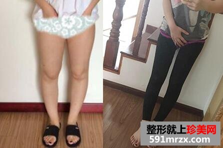大小腿水动力吸脂前后对比照片，上海天大整形医院水动力吸脂瘦大腿真实案例分享