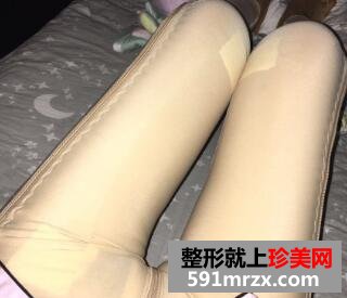 水动力吸脂瘦大小腿真实案例分享