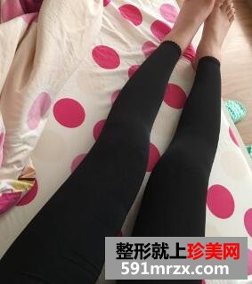上海天大整形医院水动力吸脂瘦大腿真实案例分享