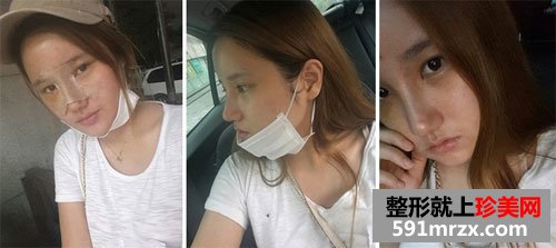 自体脂肪移植丰额头+膨体隆鼻术前后效果对比图和恢复过程