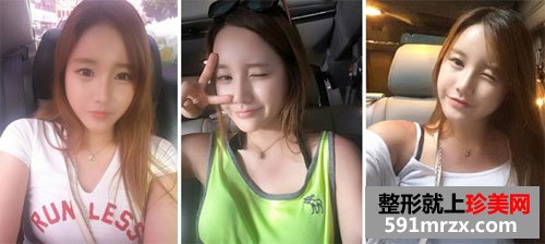 自体脂肪移植丰额头+膨体隆鼻术前后效果对比图和恢复过程