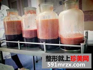 大腿+臀部吸脂手术前后效果对比图和恢复过程