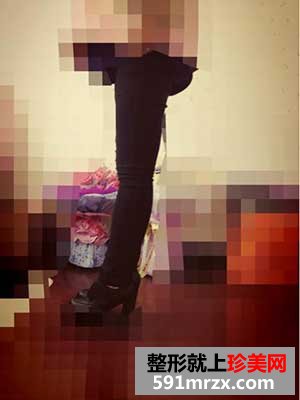 大腿+臀部吸脂手术前后效果对比图和恢复过程
