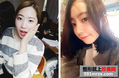 自体耳软骨隆鼻术前后效果对比图和恢复过程