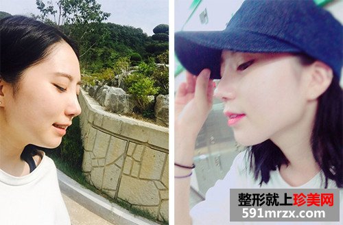 自体耳软骨隆鼻术前后效果对比图和恢复过程