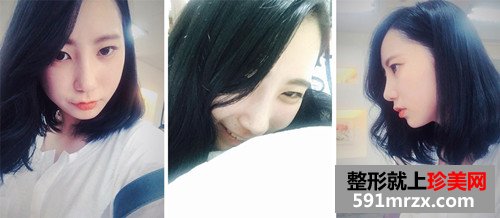 自体耳软骨隆鼻术前后效果对比图和恢复过程