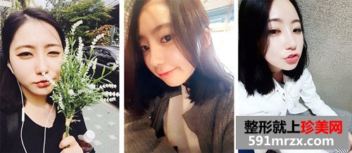 自体耳软骨隆鼻术前后效果对比图和恢复过程