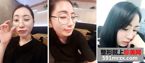 自体耳软骨隆鼻术前后效果对比图和恢复过程