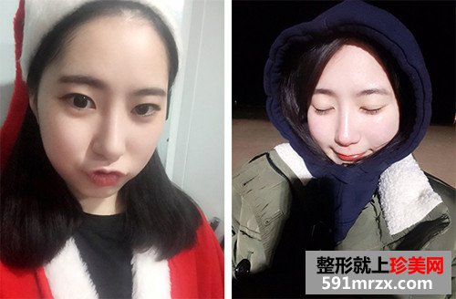 自体耳软骨隆鼻术前后效果对比图和恢复过程
