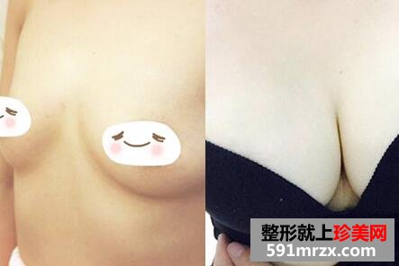 华美整形医院假体隆胸手术前后对比图真实案例分享