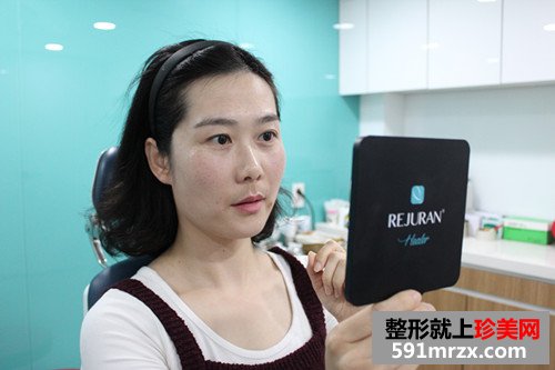 玻尿酸填充法令纹前后效果对比图和恢复过程