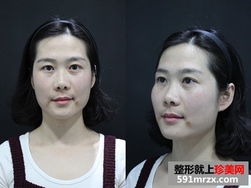玻尿酸填充法令纹前后效果对比图和恢复过程