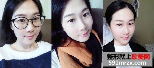 玻尿酸填充法令纹前后效果对比图和恢复过程