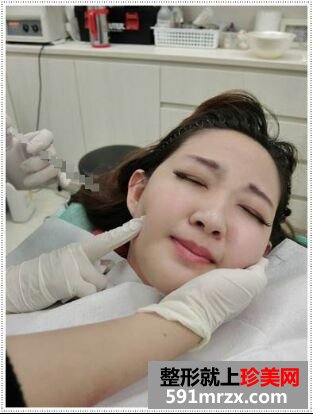 刚打了玻尿酸隆鼻和瘦脸 超期待效果