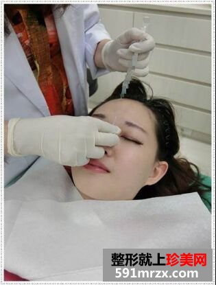 刚打了玻尿酸隆鼻和瘦脸 超期待效果