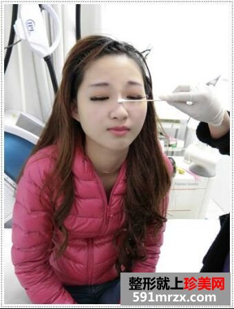 刚打了玻尿酸隆鼻和瘦脸 超期待效果