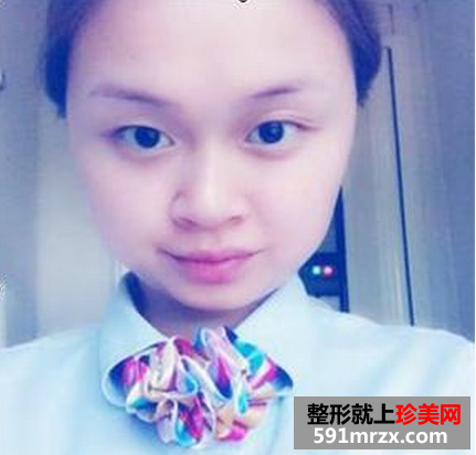 双眼皮加隆鼻溶脂针效果恢复过程