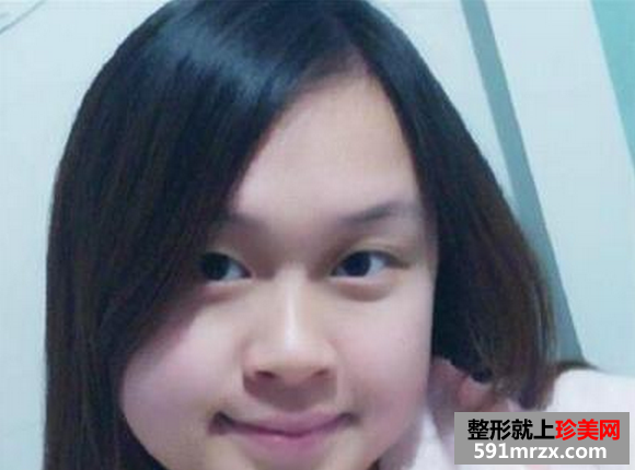 双眼皮加隆鼻溶脂针效果恢复过程