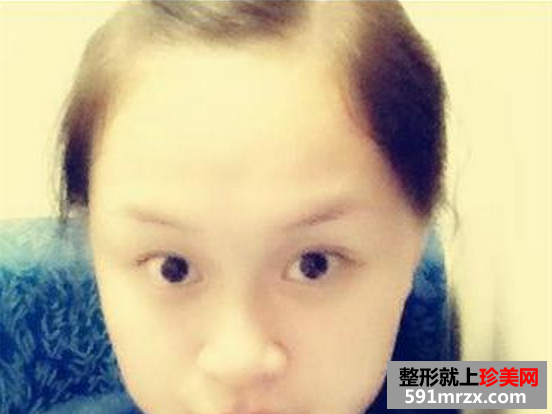 双眼皮加隆鼻溶脂针效果恢复过程